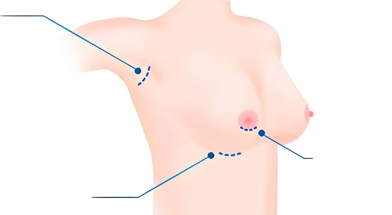 Various sizes for breast augmentation